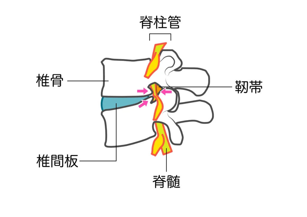 脊柱管狭窄症は、この脊椎が何らかの形で変形・狭くなることで神経が圧迫されている状態を指します。