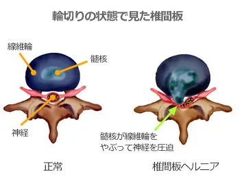 輪切りの状態で見た椎間板_ヘルニア_ヘルニコア注射