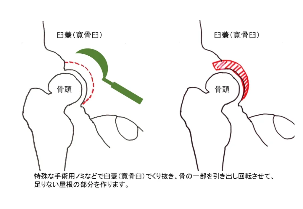 図_股関節 痛み 直し方