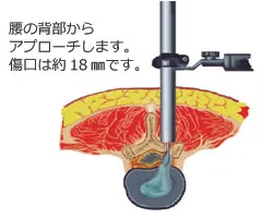 MED（内視鏡下腰椎椎間板ヘルニア摘出術）_ヘルニア_ヘルニコア注射