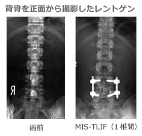 背骨を真正面から撮影したレントゲン_ヘルニア_ヘルニコア注射
