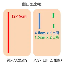 従来の固定術と比較して傷口が小さくなっている様子_MIS-TLIF（低侵襲椎間孔進入椎体間固定術）