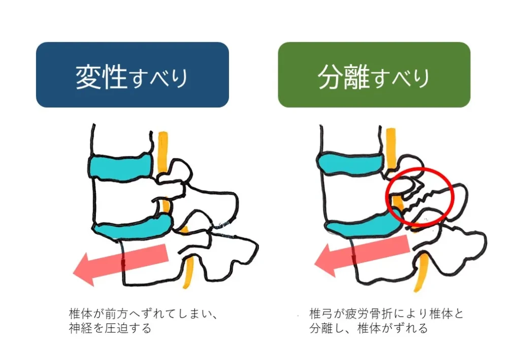 すべり症図