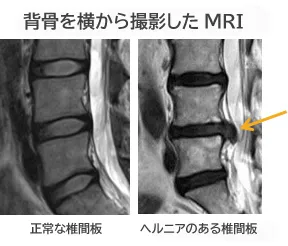 背骨を横から撮影したMRI_ヘルニア_ヘルニコア注射