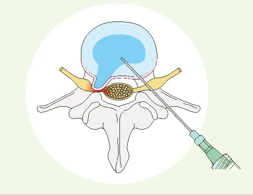 ヘルニア 腰椎椎間板注射療法（髄核）融解術（ヘルニコア、コンドリアーゼ）の