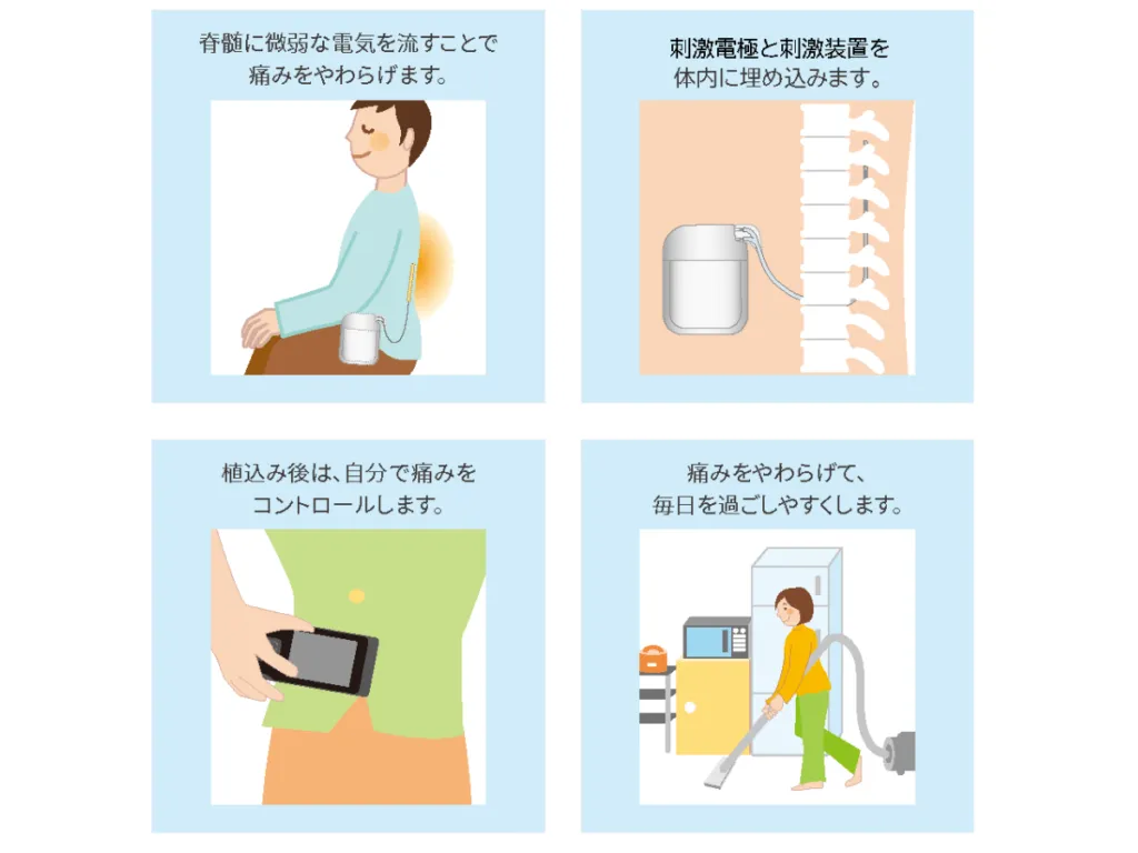 SCS（脊髄刺激療法）とは脊髄内に直接電極を埋め込み、脊髄から脳への刺激をコントロールして痛みを緩和する治療法です。