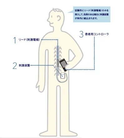 SCSの装置は電極（リード）、刺激装置、コントローラーで構成されています。